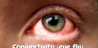 Conjunctivitis (eye flu)